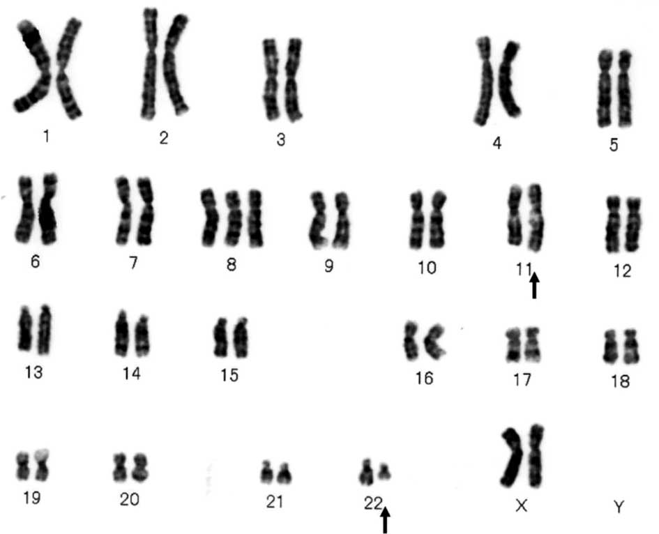 Хромосомы лучше видны. Трисомия 22 хромосомы кариотип. Синдром Варкани кариотип. Синдром трисомии х хромосомы кариотип. Трисомия 8 хромосомы кариотип.