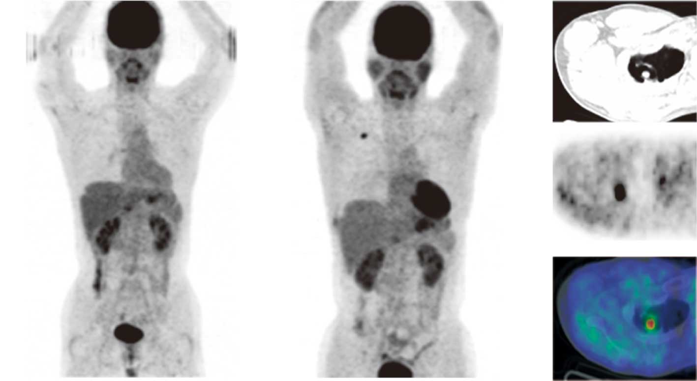 A case of primary lung cancer lesion demonstrated by F-18 FDG positron