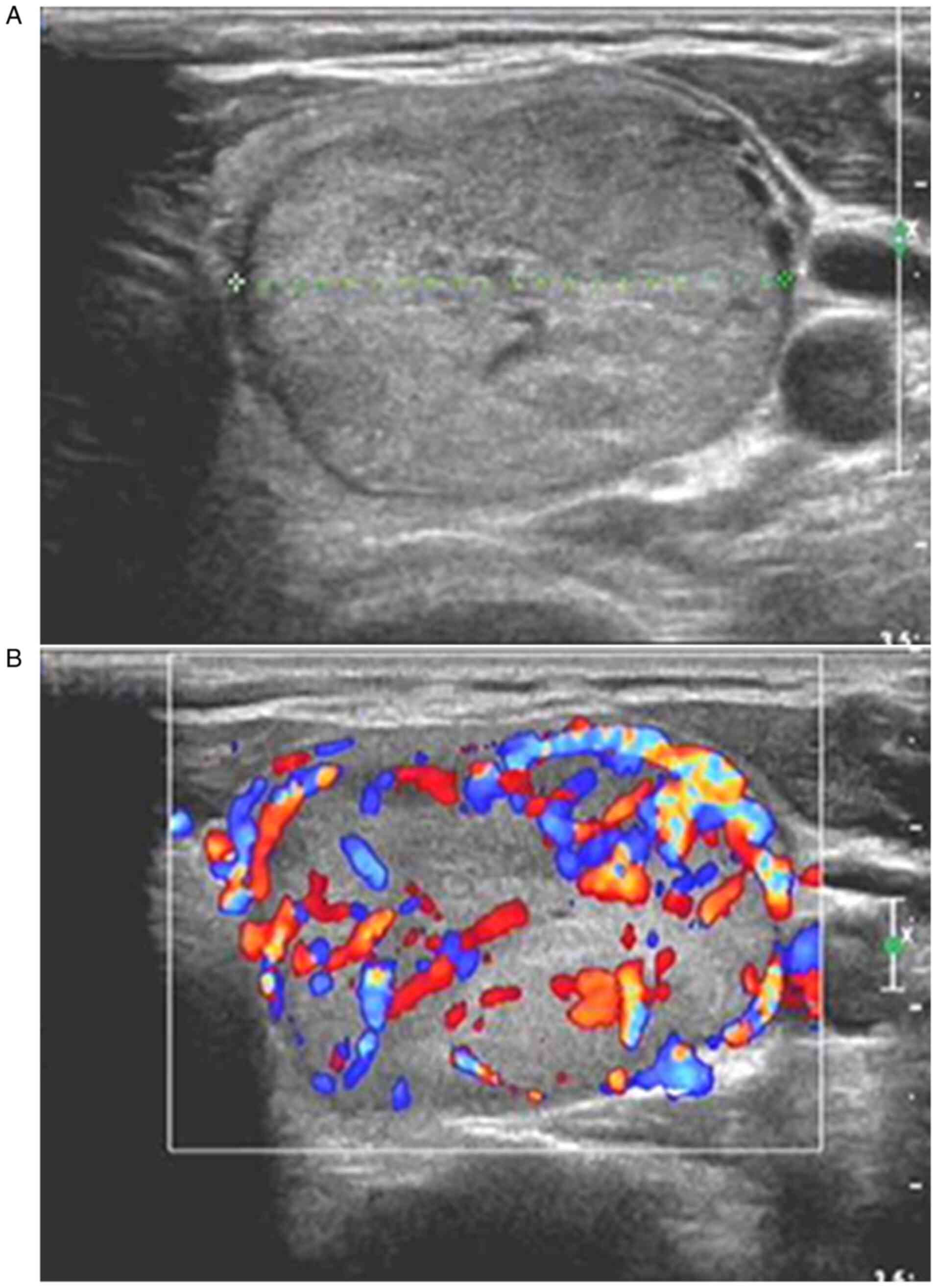 Clinical Value Of Color Doppler Ultrasound Combined With Serum Tumor