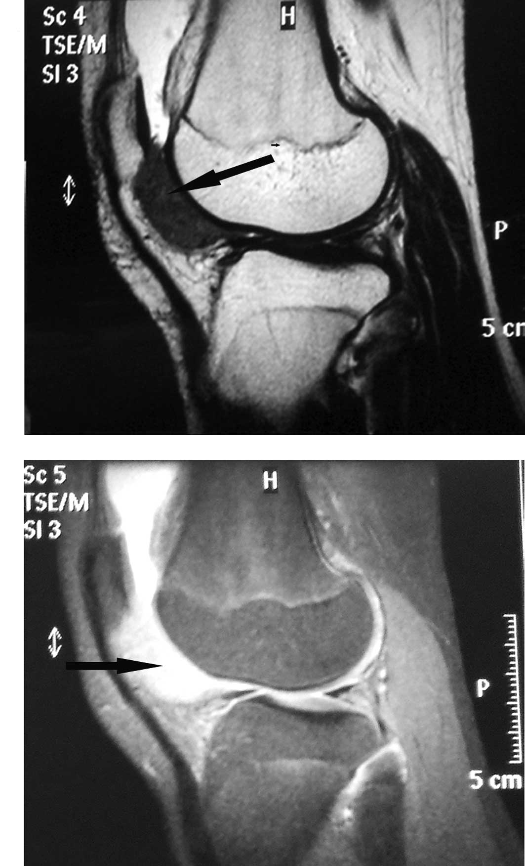Giant cell tumor of the tendon sheath: A rare case in the left knee of