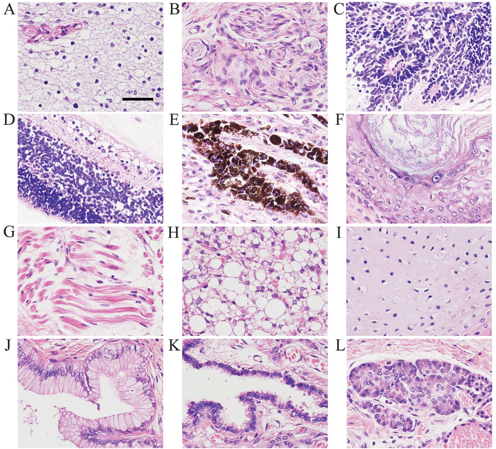 Teratoma Histology Teratoma Histology