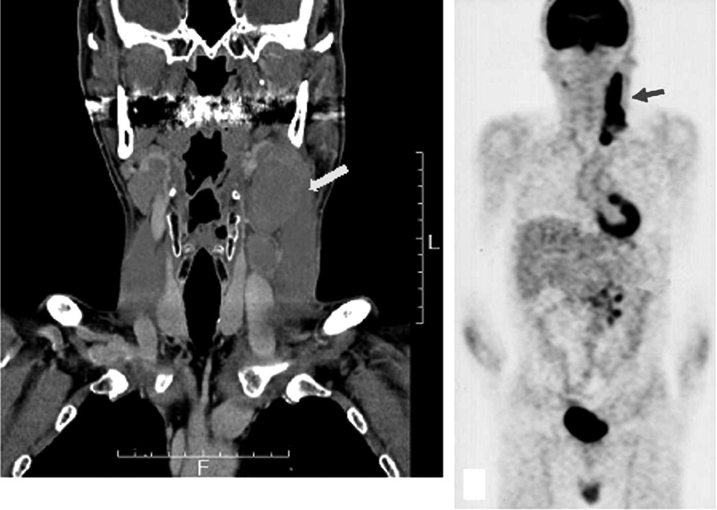 Epstein Barr Virus Associated Lymphoproliferative Disorder Developed