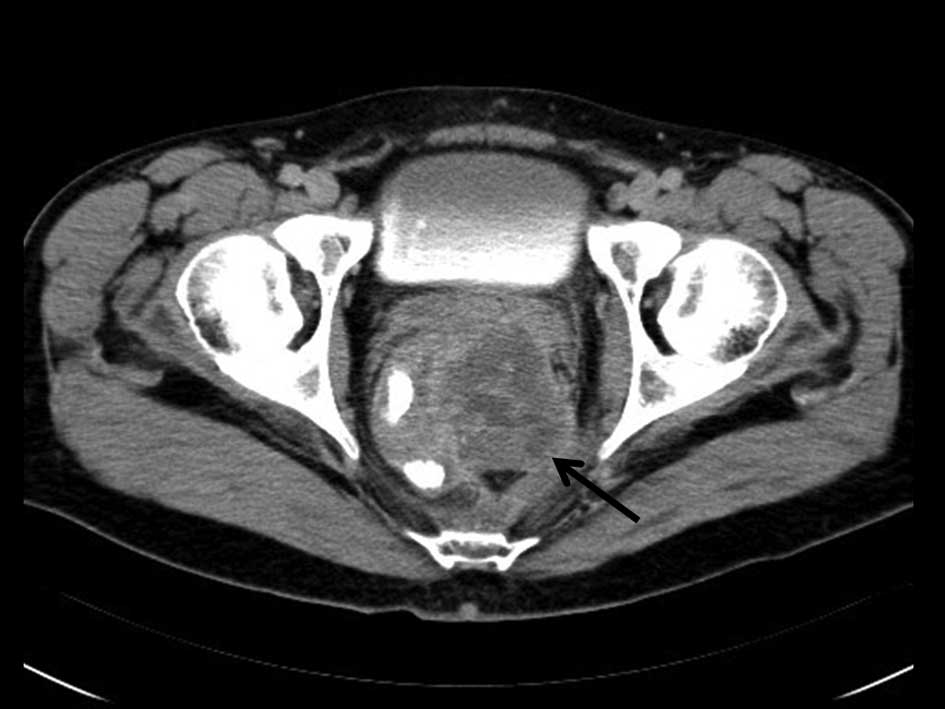 Neoadjuvant treatment of rectal cancer