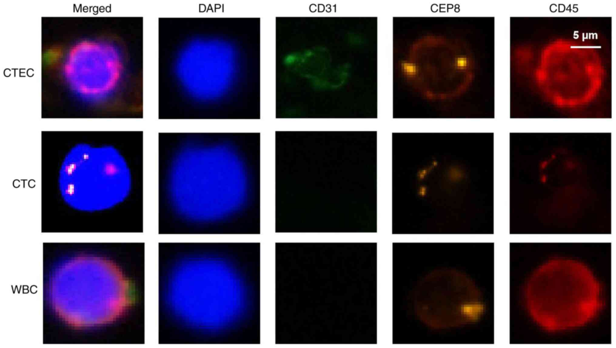 Identification of CTEC, CTC and WBC
by subtraction enrichment and immunostaining-fluorescence in
situ hybridization (scale bar, 5 µm). CD45, red; CD31, green;
CEP8, orange; DAPI, blue. The CTEC image (middle panel) has been
replaced with a more representative cell exhibiting stronger CD31
(green) fluorescence. CTC, circulating tumor cells; CTEC,
circulating tumor-derived endothelial cells; WBC, white blood
cells; CEP8, centromere probe 8.