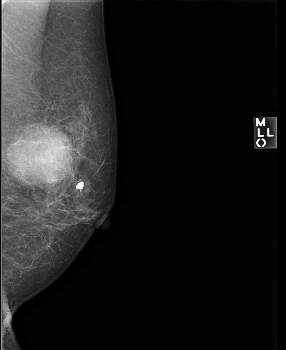What are some characteristics of a suspicious mammogram?