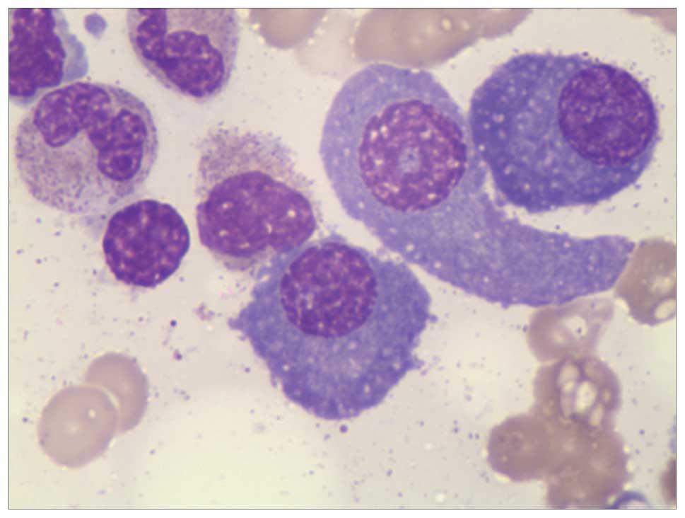 What is plasma cell myeloma?