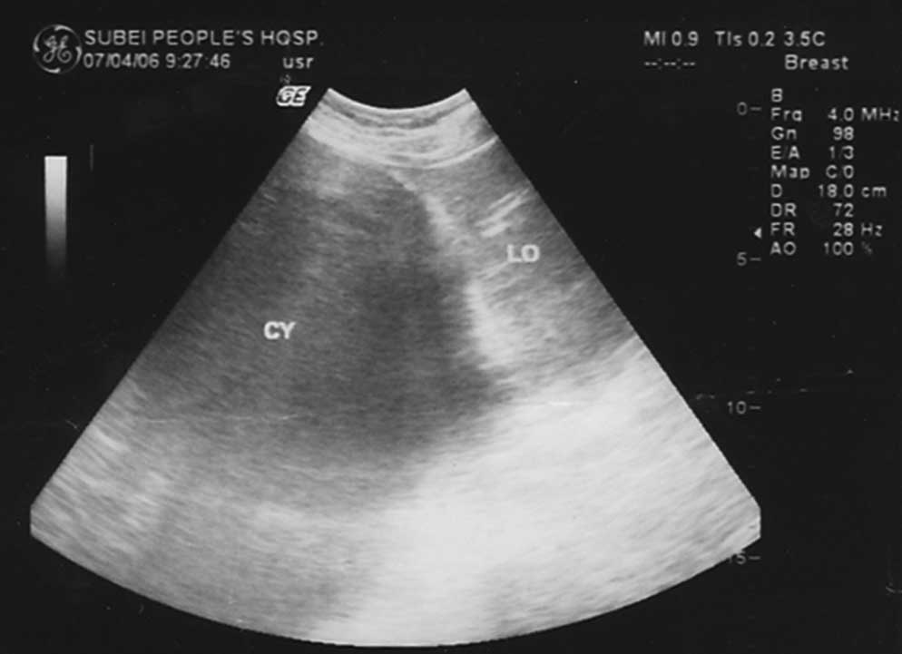 A case of congenital giant gallbladder with massive hydrops mimicking ...