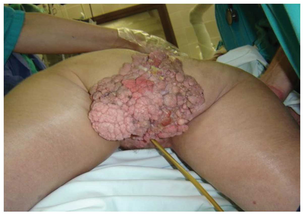 Genital Warts (HPV) Picture Image on MedicineNet.com