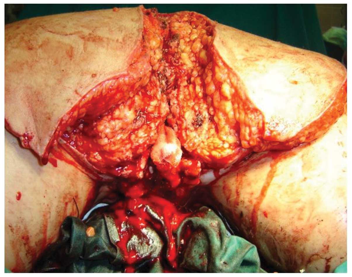 a condyloma tumor