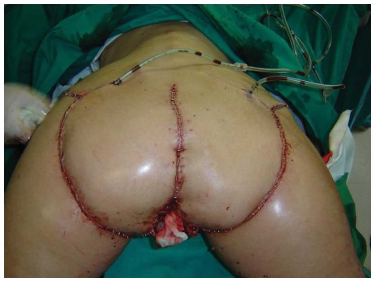 Lézerek gyakorlati alkalmazása a proctológiai sebészetben A külső nyílás condyloma