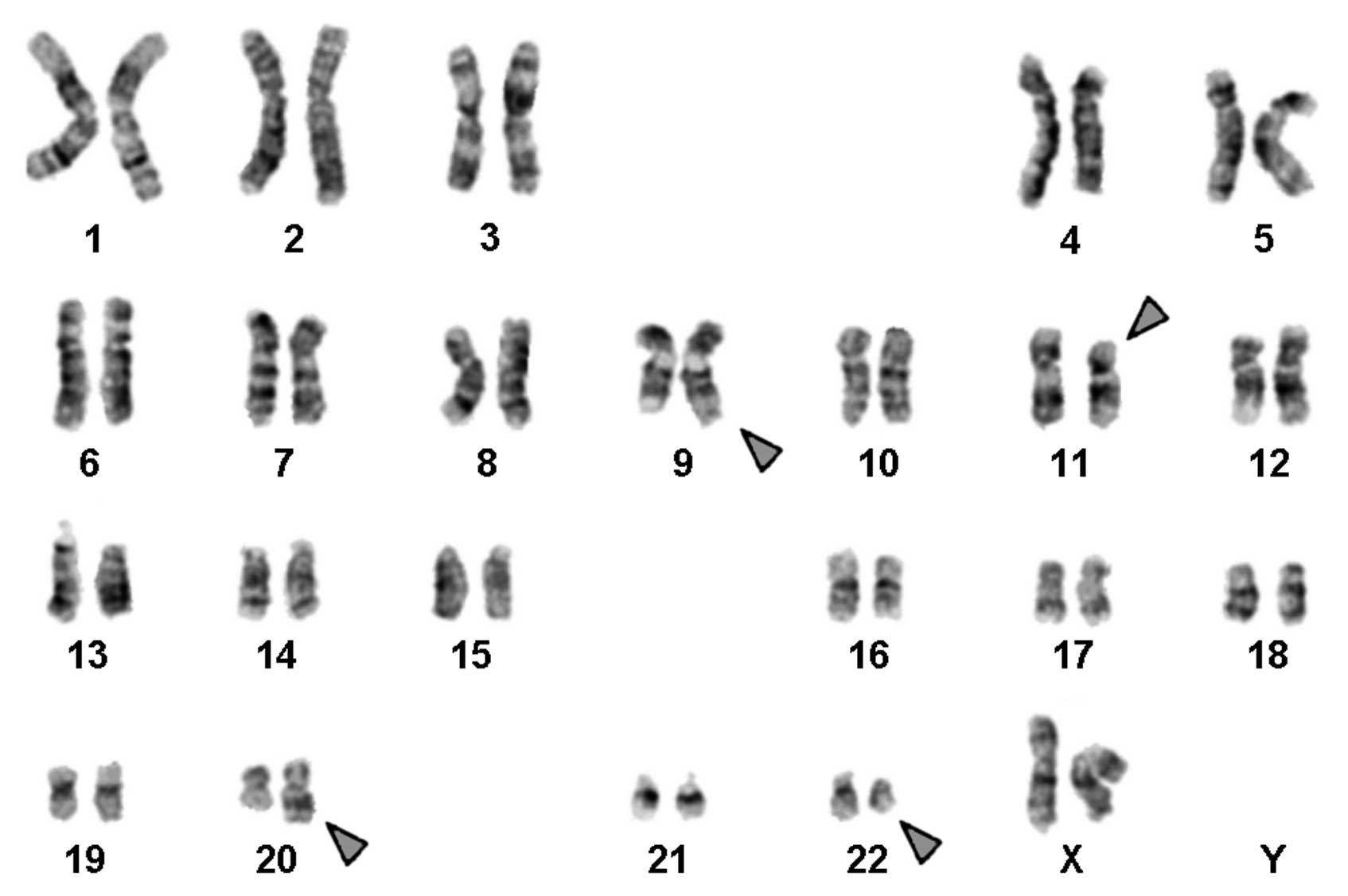 Пересадка хромосом. Трисомия 22 хромосомы кариотип. Синдром Дауна трисомия 21 хромосомы. Хромосомная патология трисомия хромосомы 16. Кариотип хронического миелолейкоза.