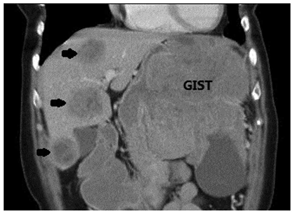 One Stage Laparoscopic Resection For A Large Gastric Gastrointestinal