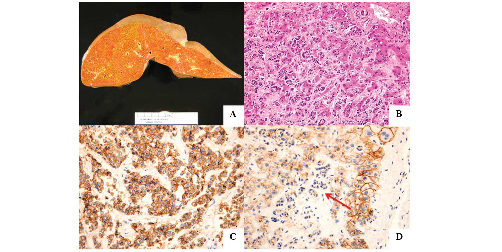 pancreatic cancer hepatic encephalopathy