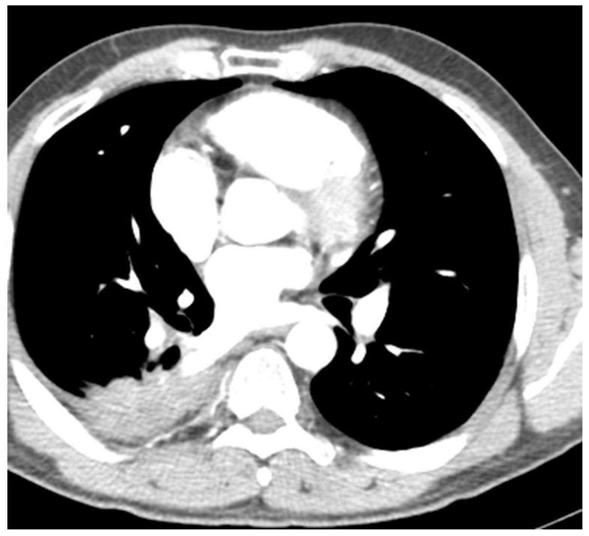 Metastasis to the colon from lung cancer presenting with severe
