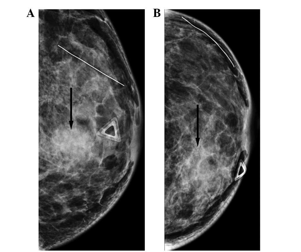 Breast Metastasis From Nasopharyngeal Carcinoma A Case Report And Review Of The Literature