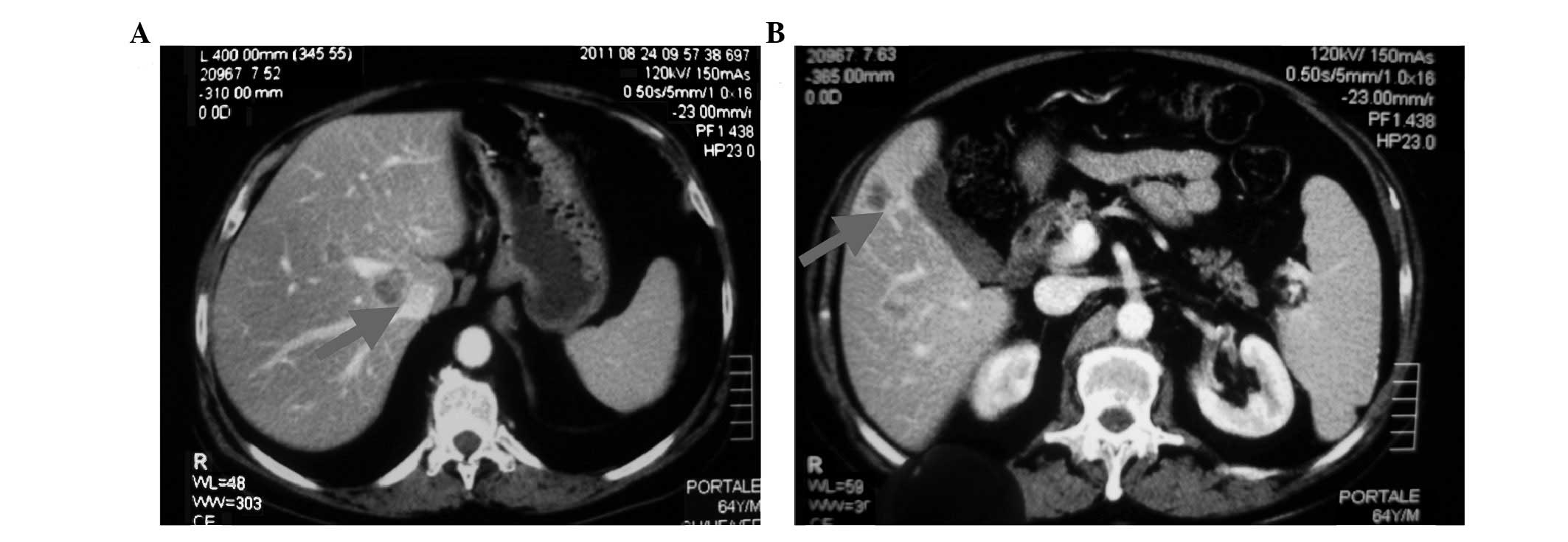 prostate cancer with metastasis to liver