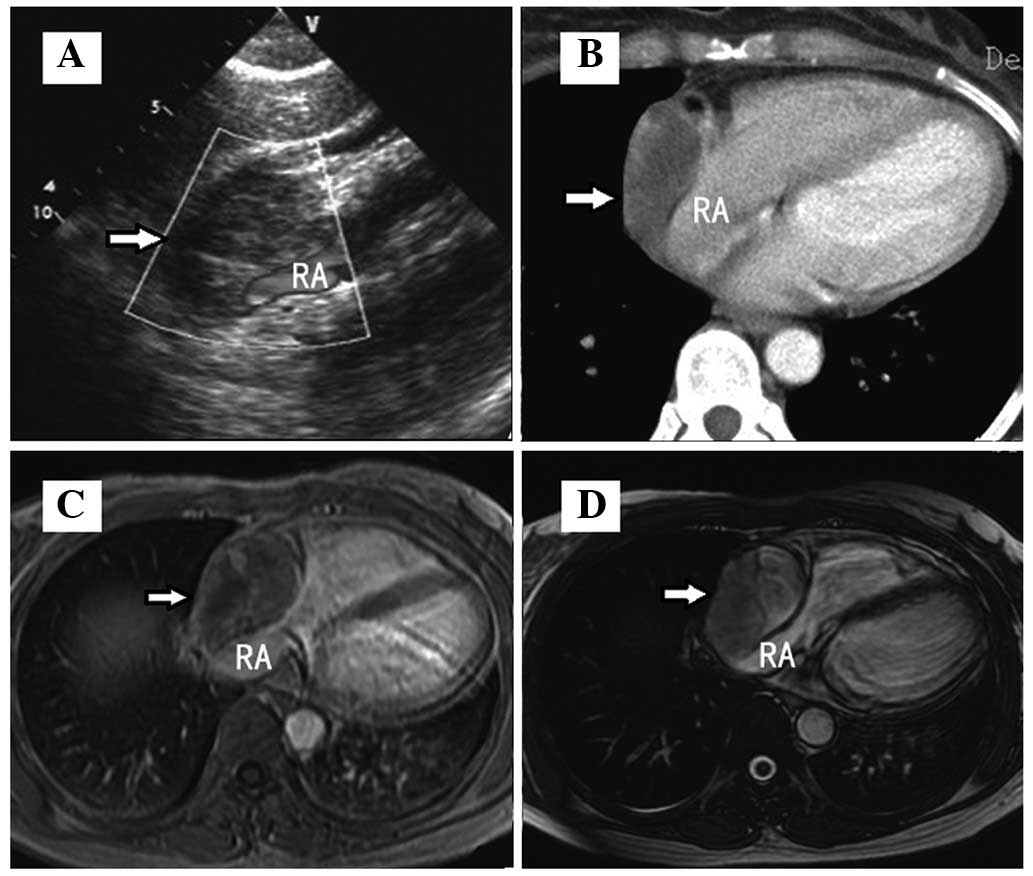 Pericardial synovial sarcoma in a dyspnoeic female with tuberculous ...