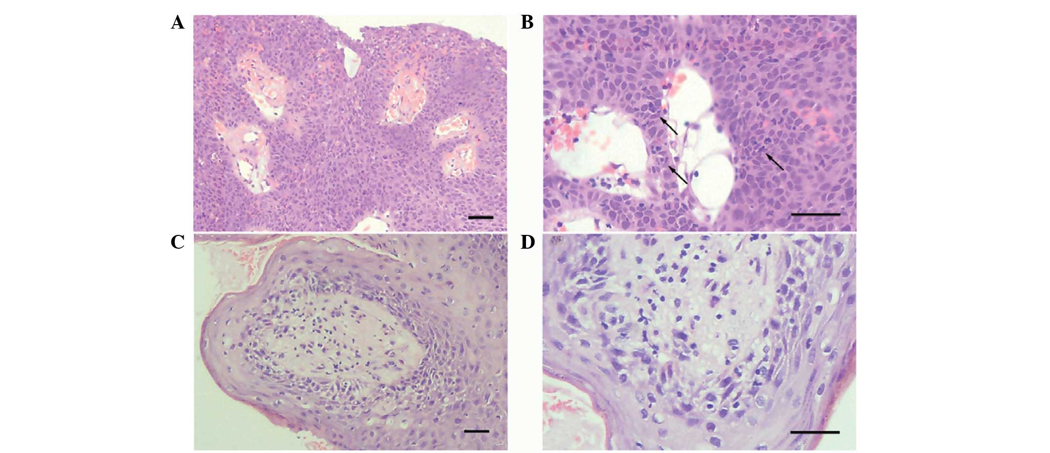 squamous papilloma bone)