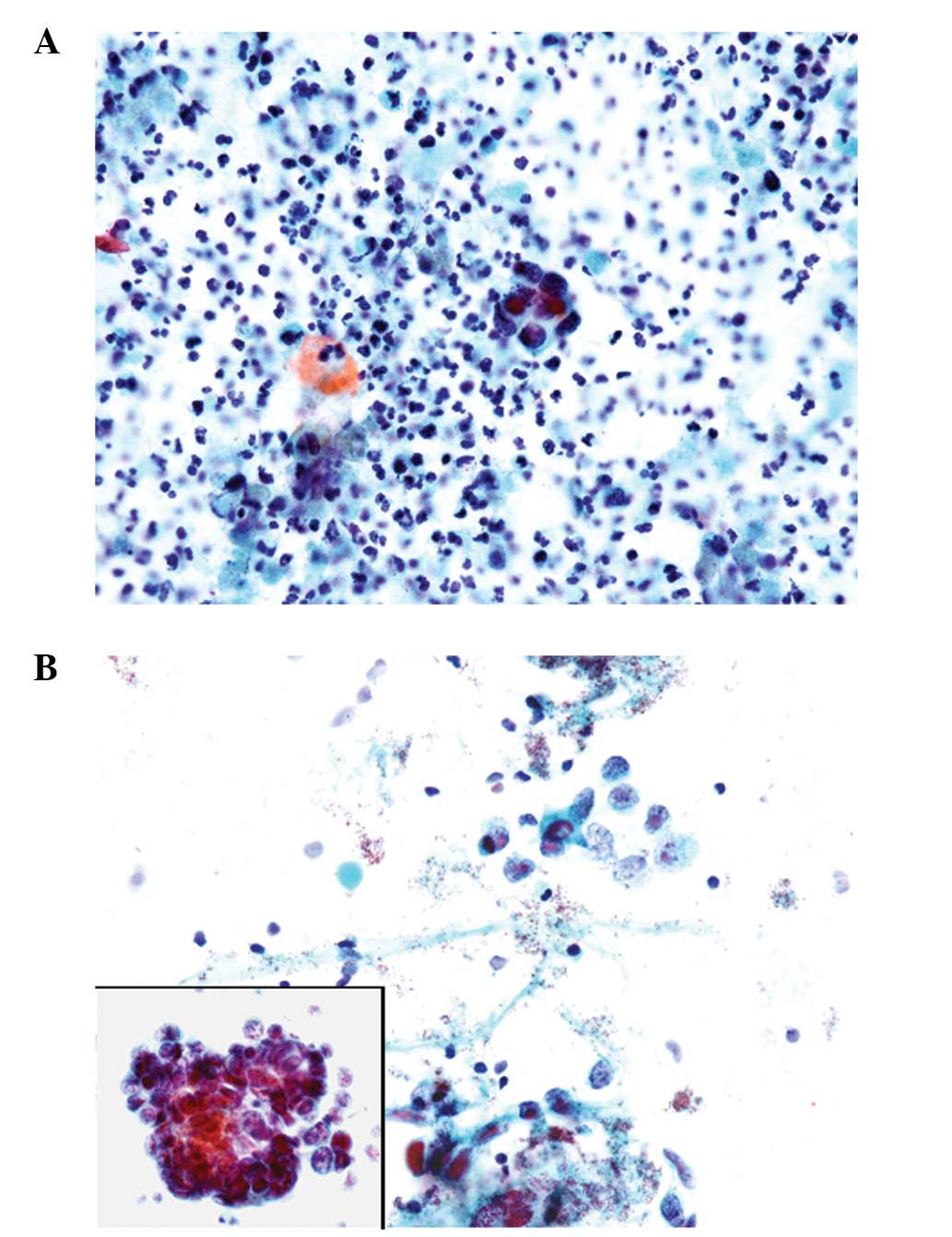 prostate adenocarcinoma cytology)