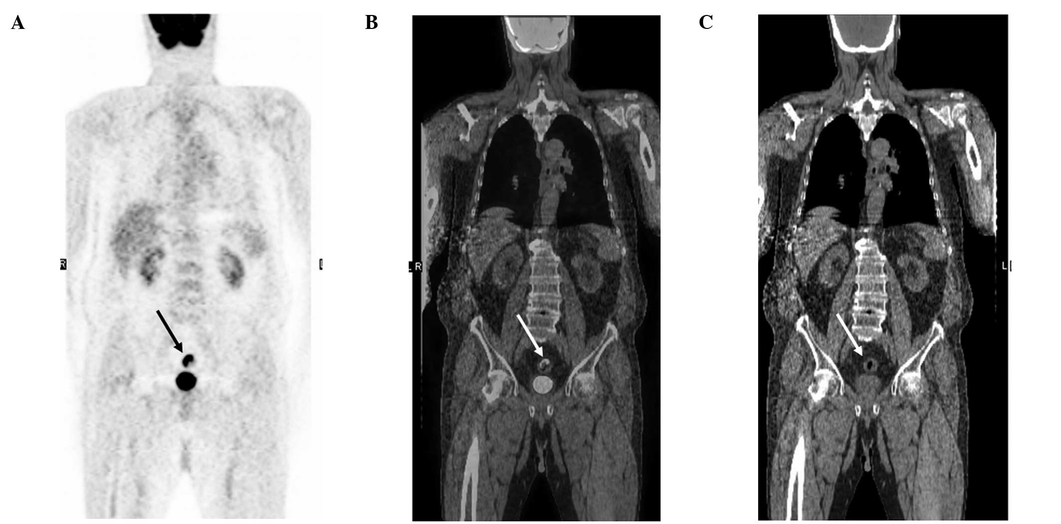 pet scan colon cancer