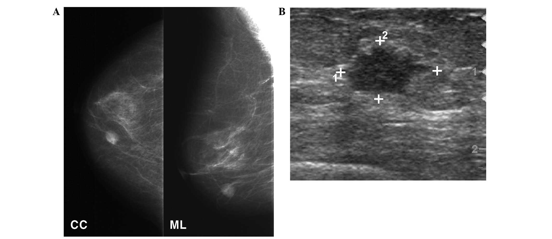 Secretory Breast Carcinoma A Report Of Three Cases And A Review Of The Literature