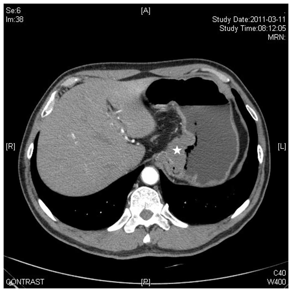 Adenoid Cystic Carcinoma Of The Cardia Report Of A Rare Case And