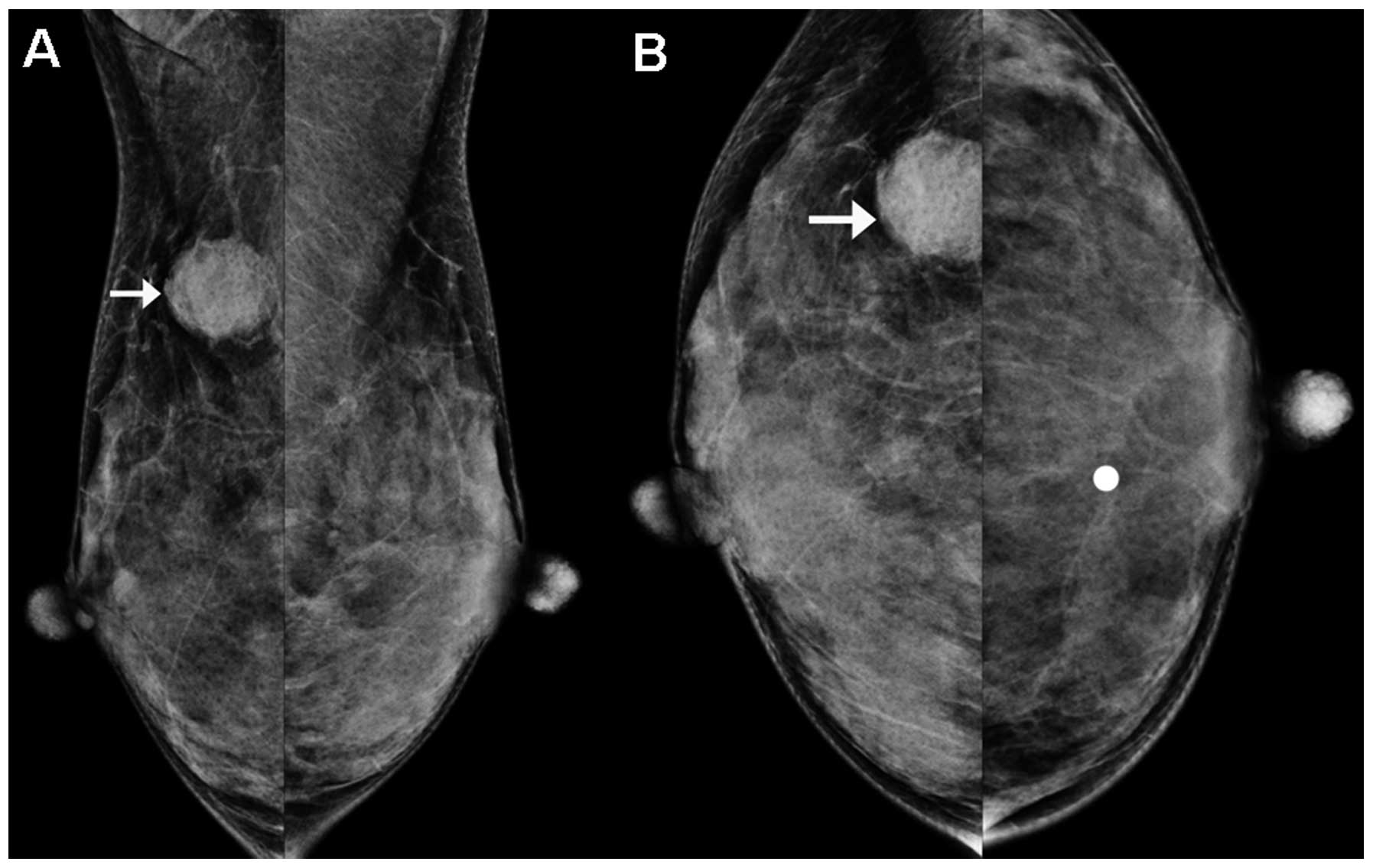 Esthesioneuroblastoma Metastasis To The Breast A Case Report And