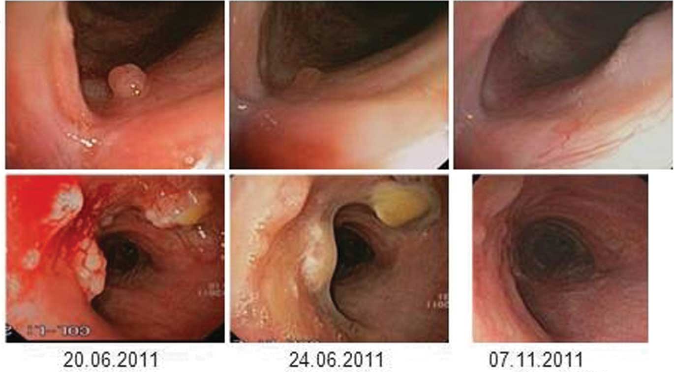 juvenile onset laryngeal papillomatosis