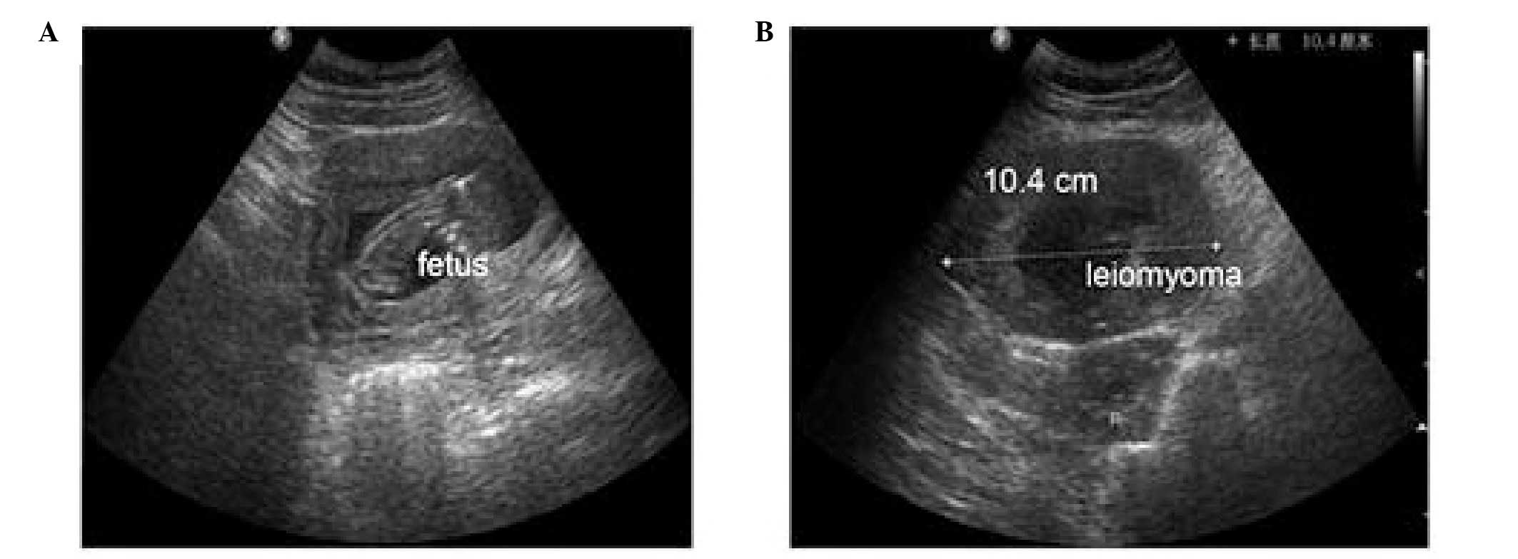 Laparoscopic tumorectomy for a primary ovarian leiomyoma during