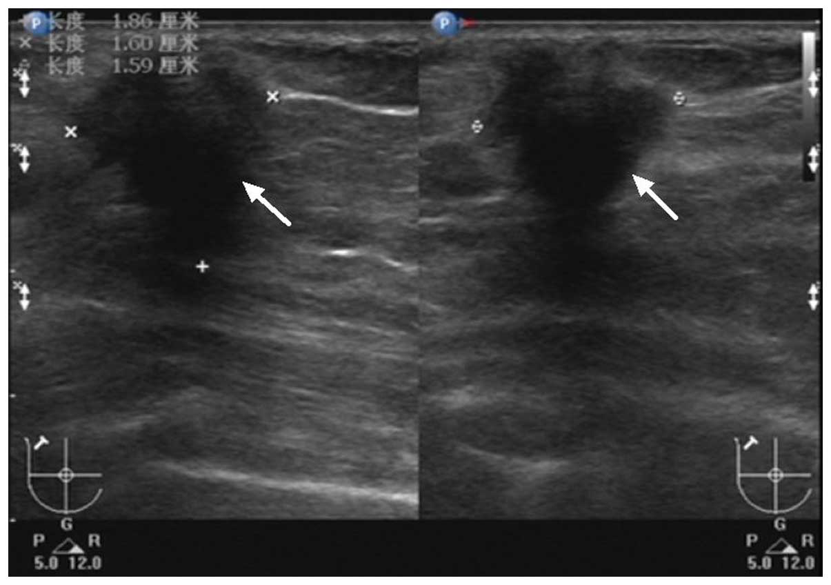 The lactating breast mri findings and literature review