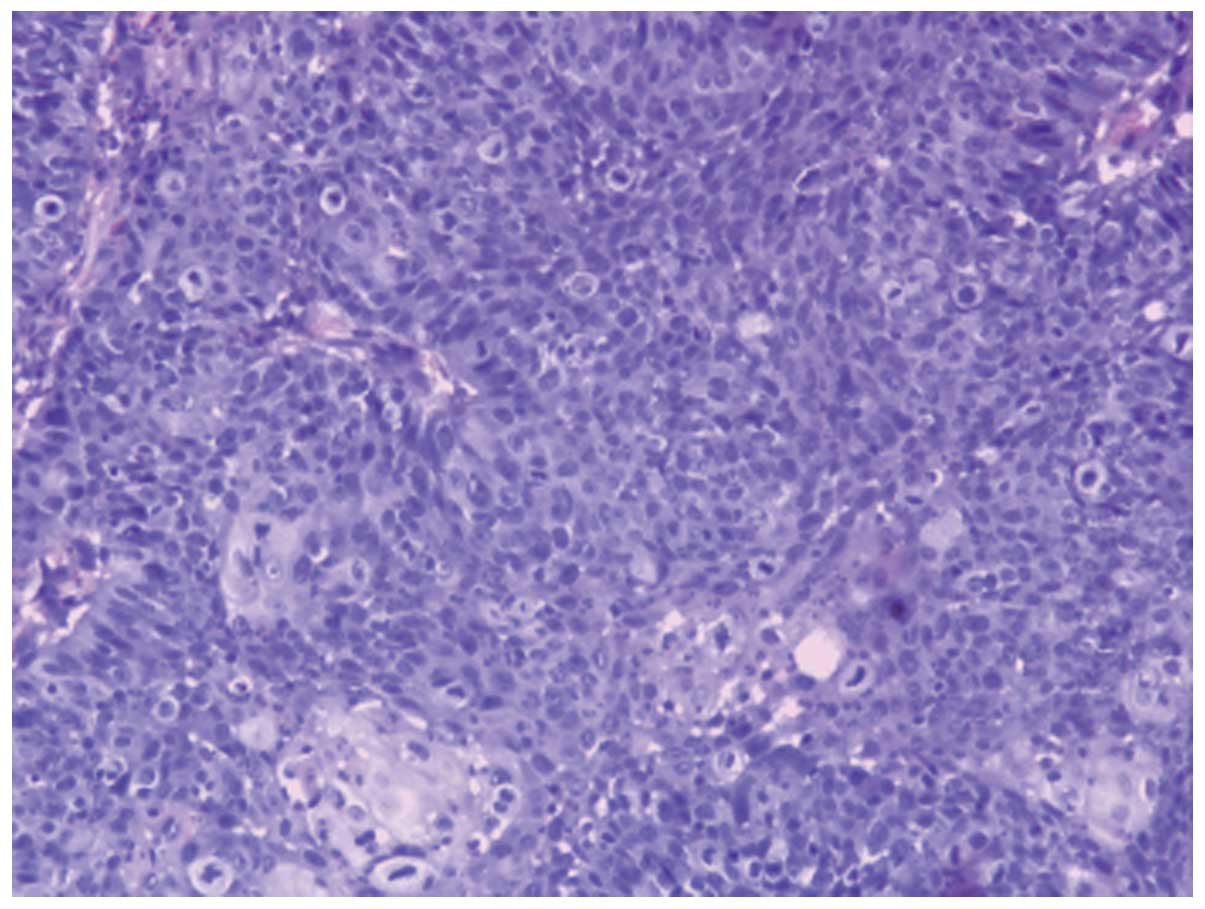 inverted papilloma malignant degeneration