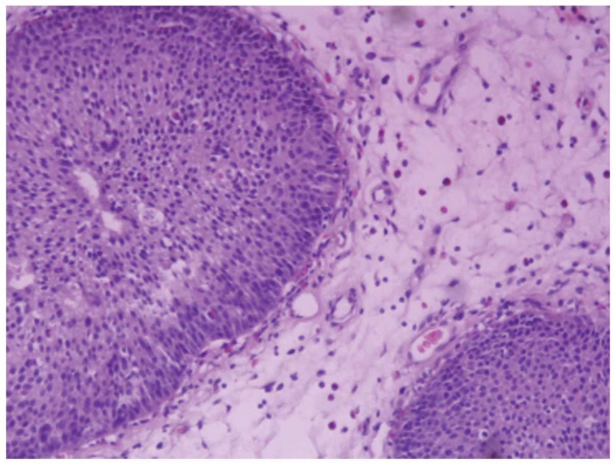 inverted papilloma malignant change