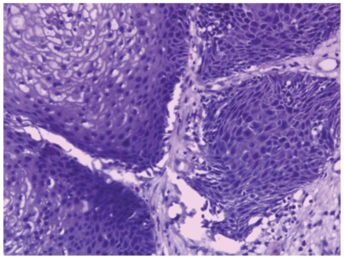 Nasal papilloma malignant. Inverted papilloma with squamous cell carcinoma