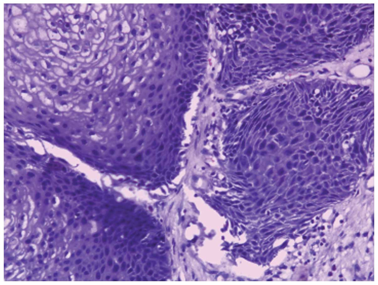 inverted papilloma malignant degeneration)