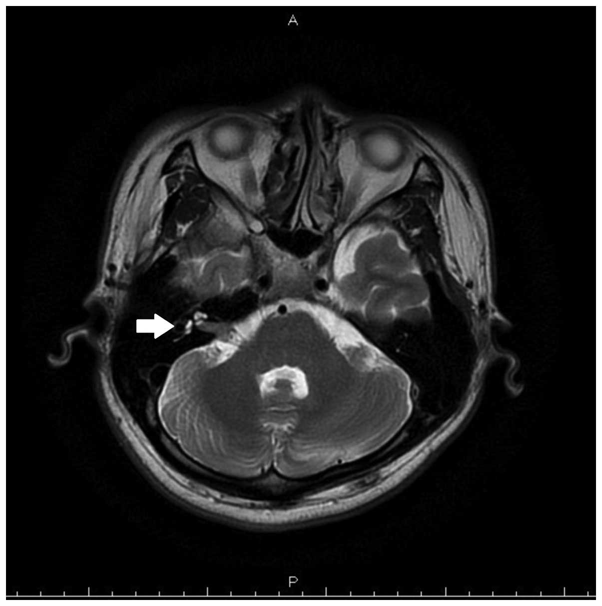 Facial Nerve Tumor 50