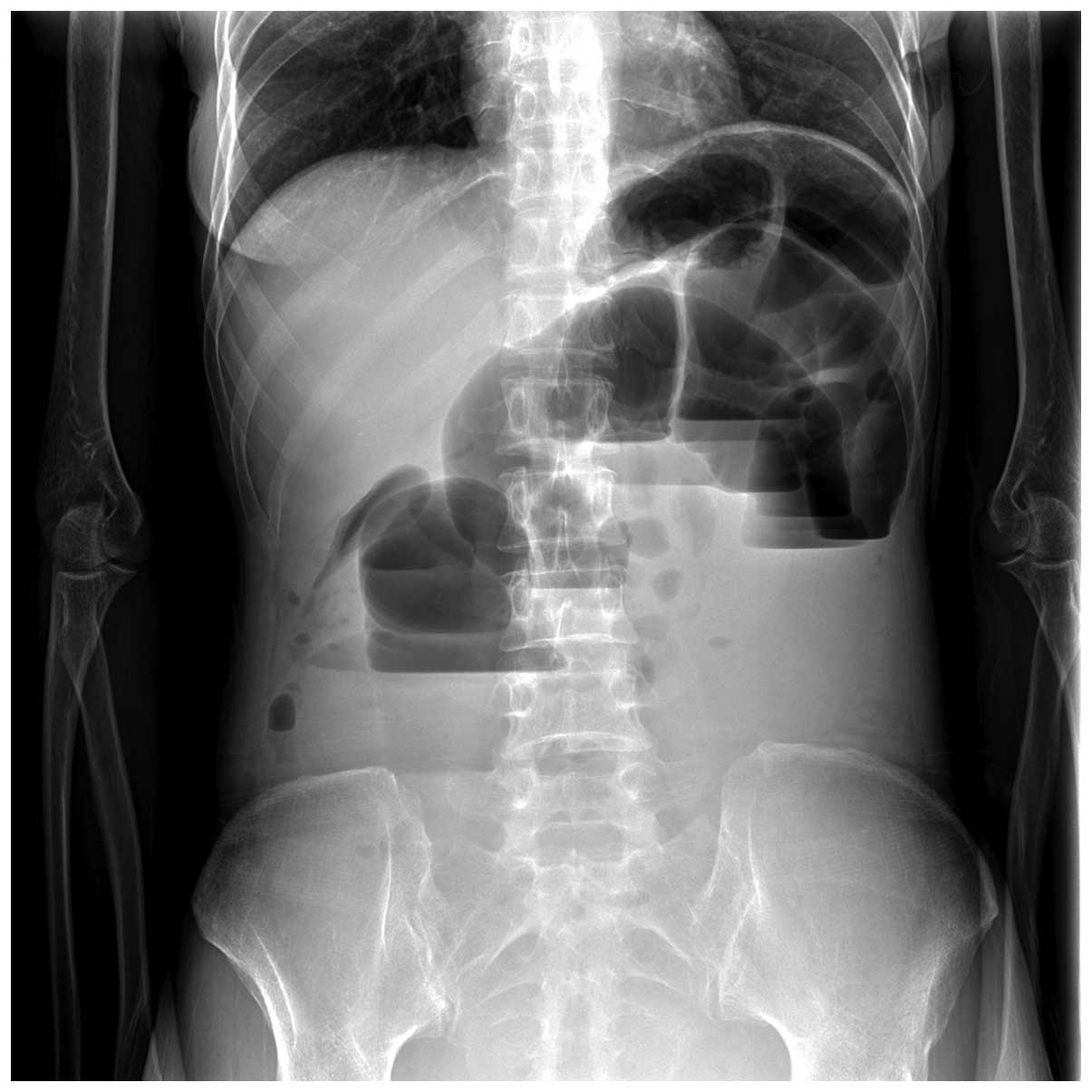 Small intestine metastasis from cervical cancer with acute ...