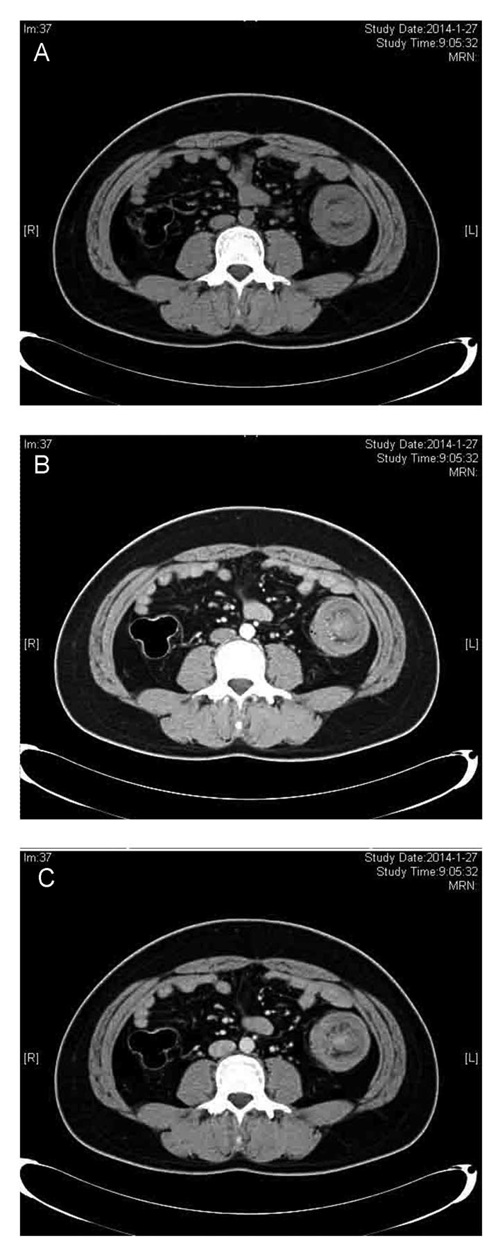 Chylothorax and lymphedema as the initial manifestations of gastric  carcinoma: A case report and review of the literature