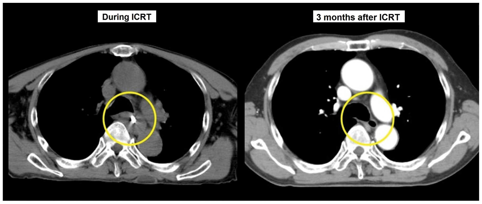 Symptom Relief Effect Of Palliative High Dose Rate Intracavitary Radiotherapy For Advanced Esophageal Cancer With Dysphagia