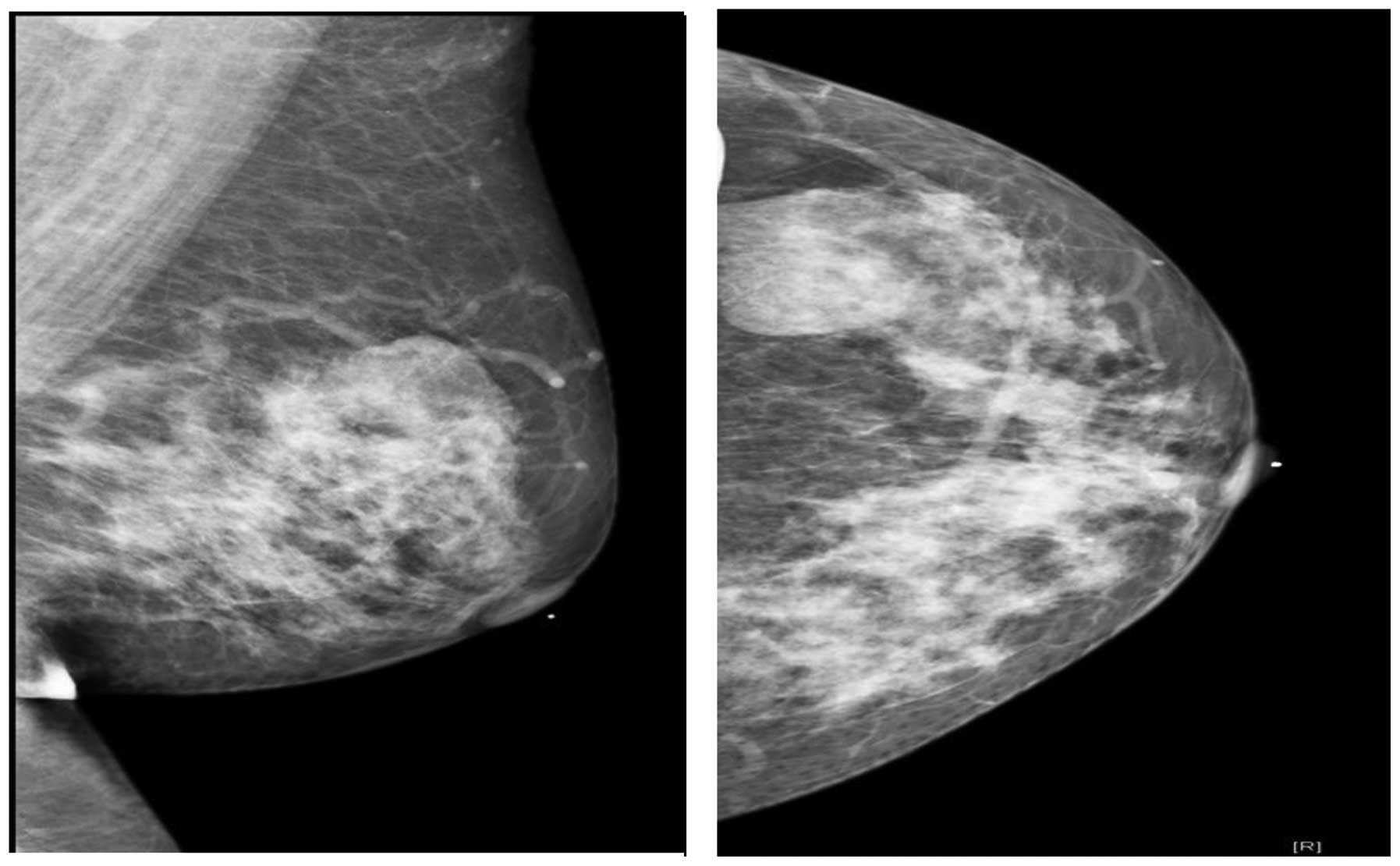 Маммография старый. Гамартома молочной железы рентген. Гамартома молочной железы маммография. Гамартома молочной железы мрт. Фиброаденолипома(гамартома).