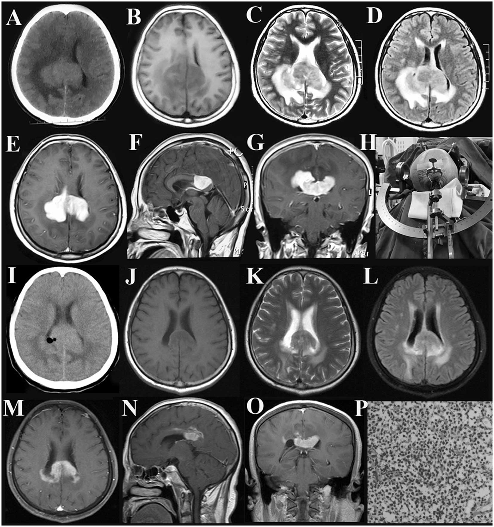 Diagnosis and treatment of primary central nervous system lymphoma: A ...