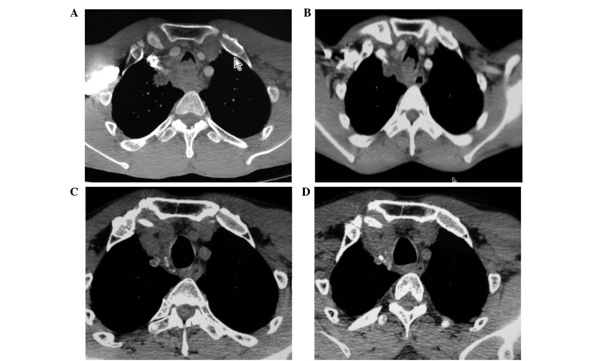 tracheal papillomatosis ct