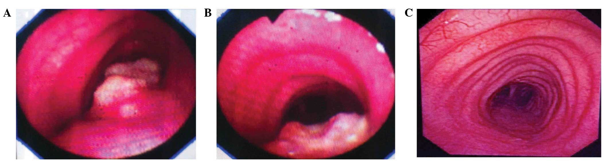 Squamous papilloma of larynx