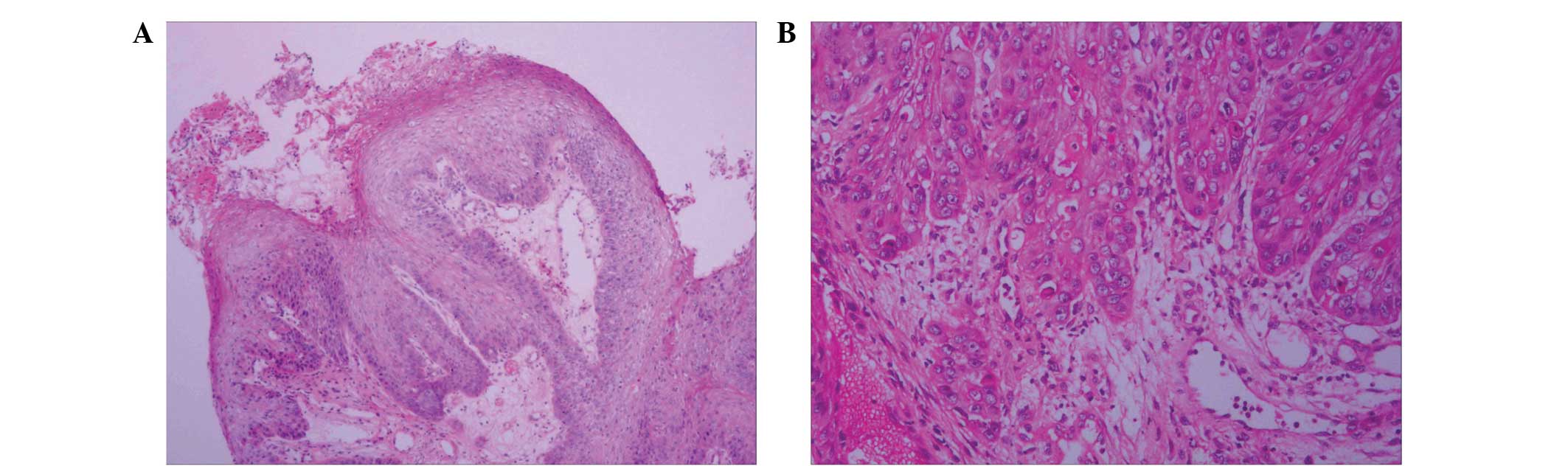 Difference between papilloma and polyp, Papillom entfernen mittel