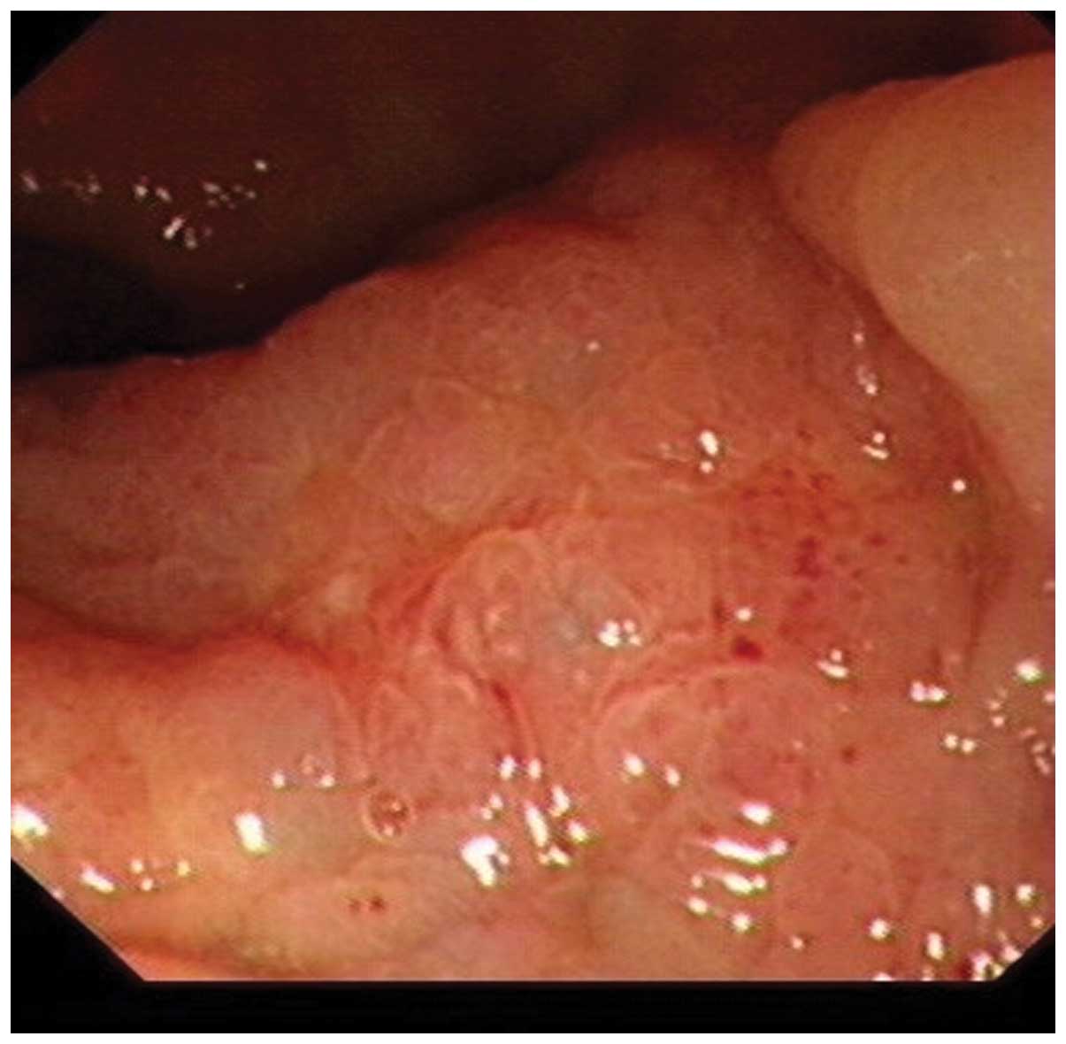 Neoadjuvant treatment of rectal cancer