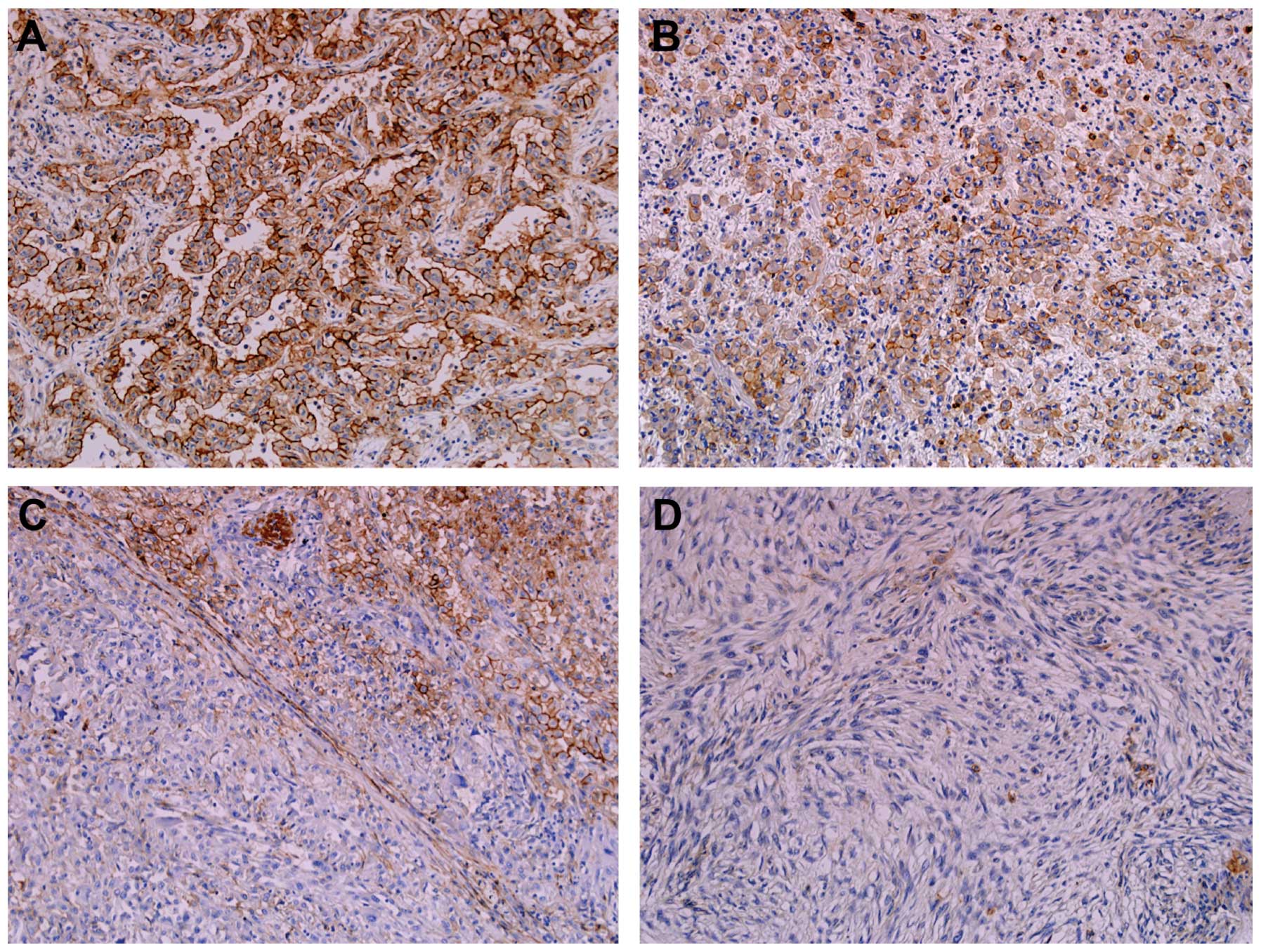 benign cystic peritoneal mesothelioma