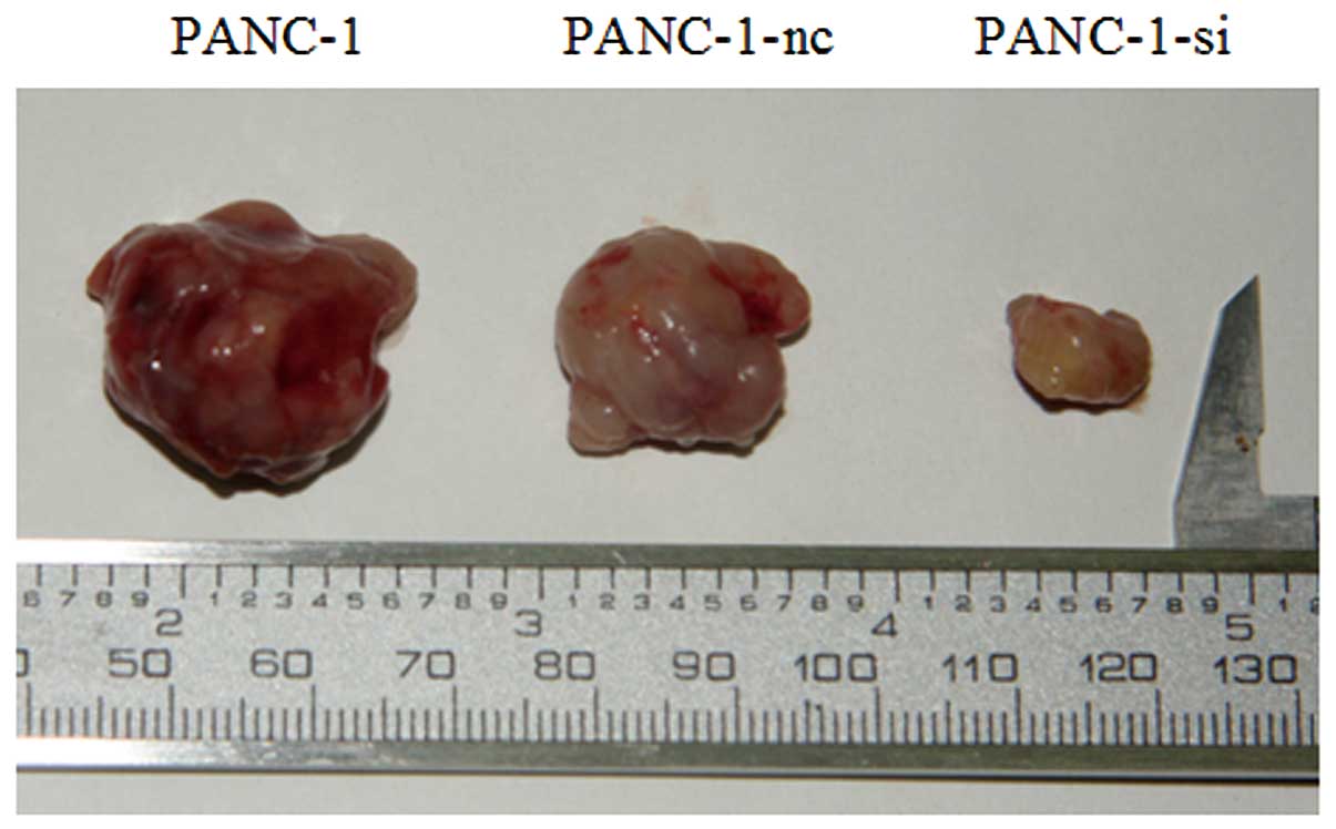 Pancreatic cancer tumor size, Socioeconomic Implications in Pancreatic Cancer