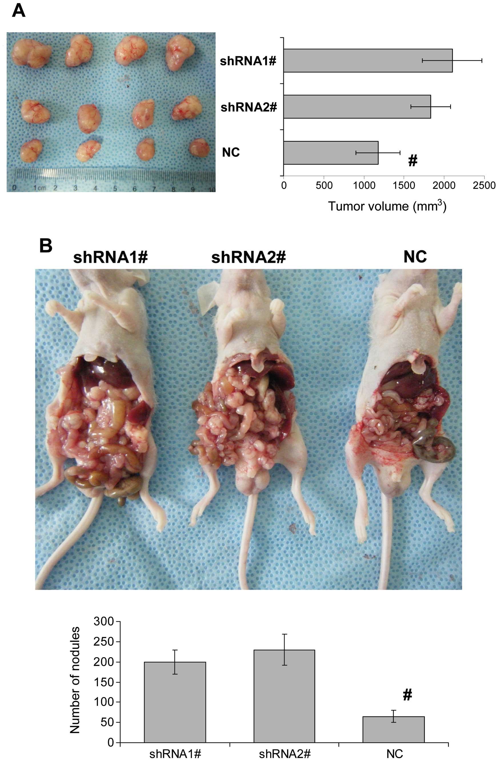 Cancer abdominal mass. Cat cancer abdominal mass - Video CSID, Ovarian cancer abdominal nodules