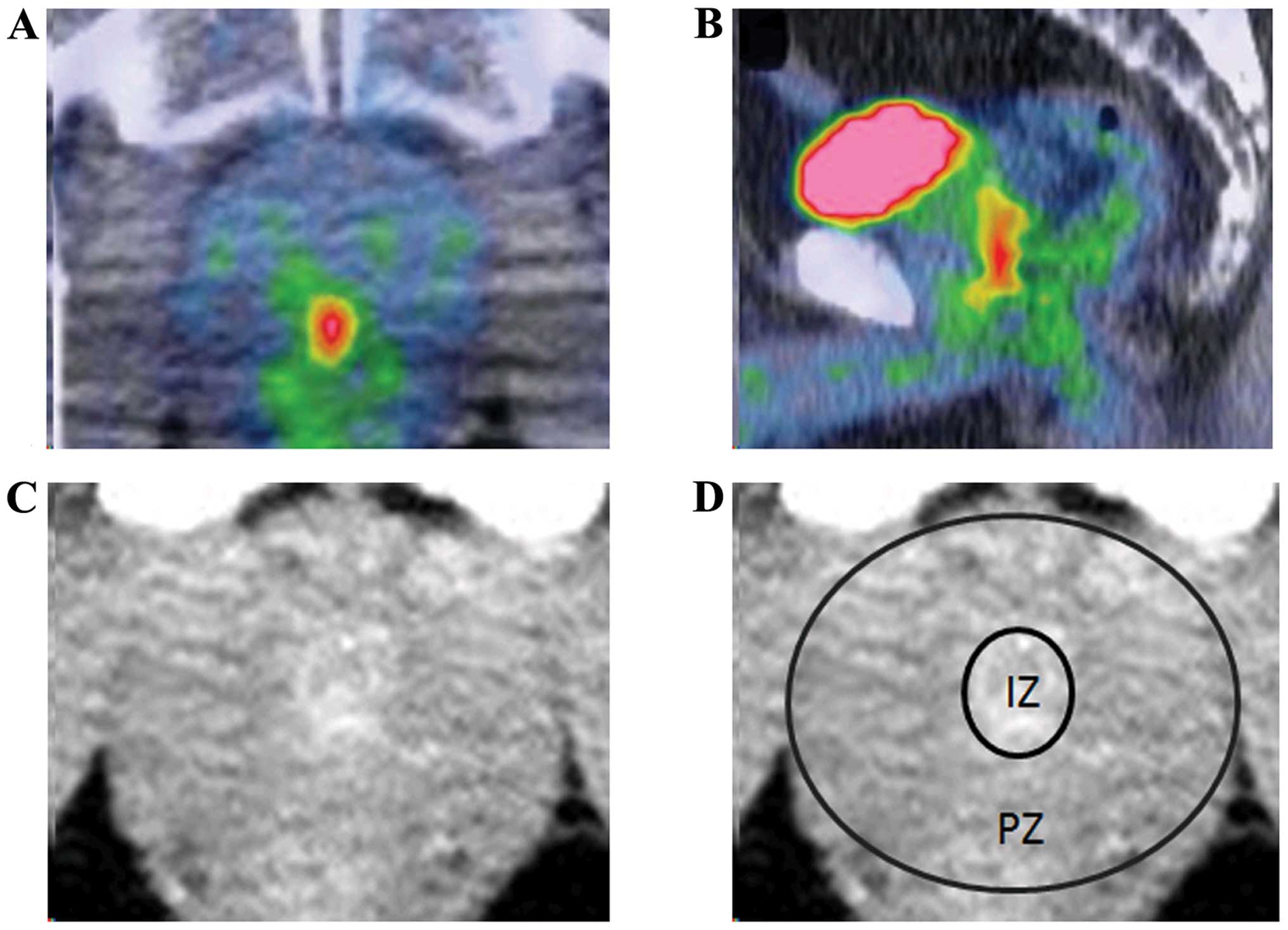 prostate calcification and psa)