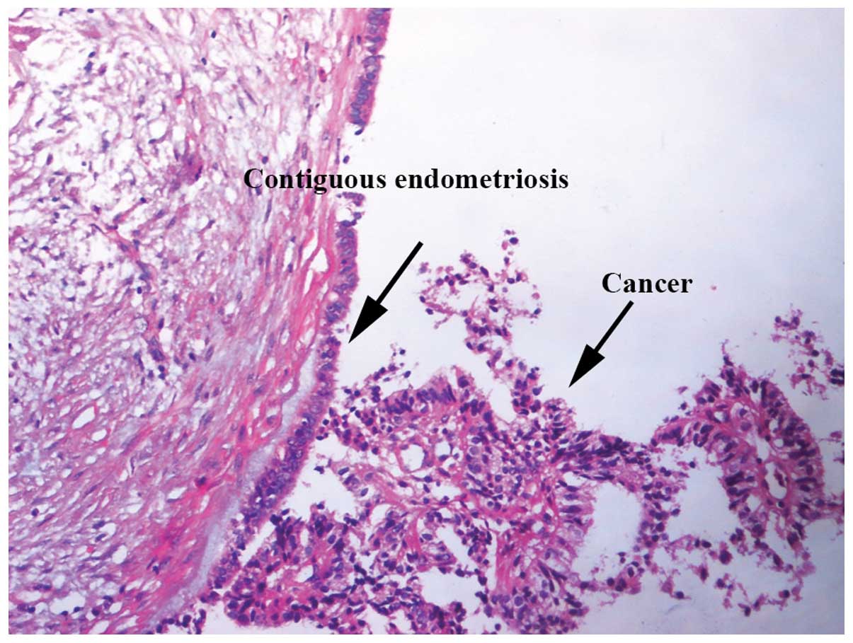 Endometriosis y cancer