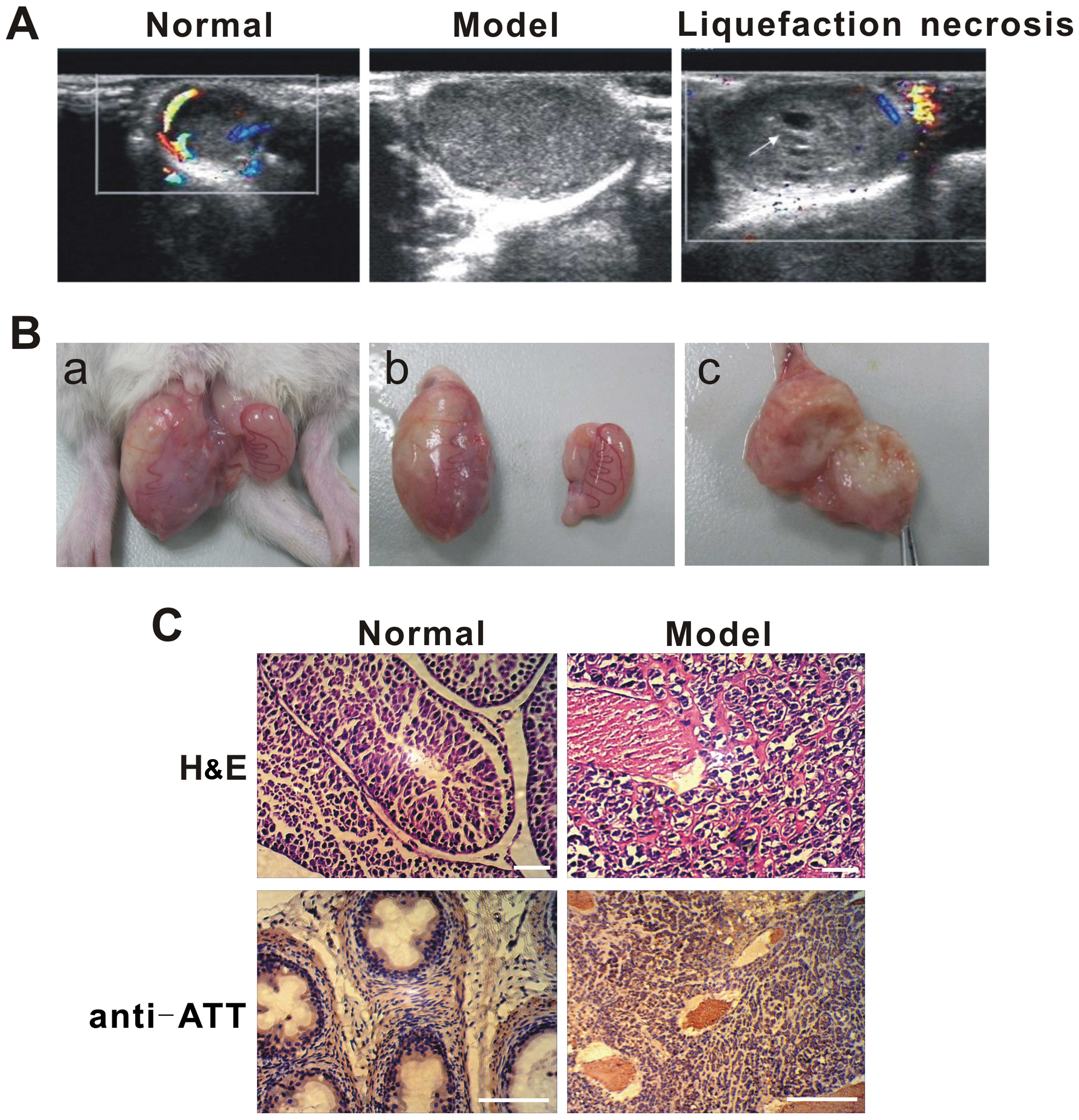 Testicular Cyst Vs Cancer